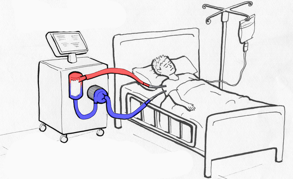 ECMO: una nuova sfida terapeutica