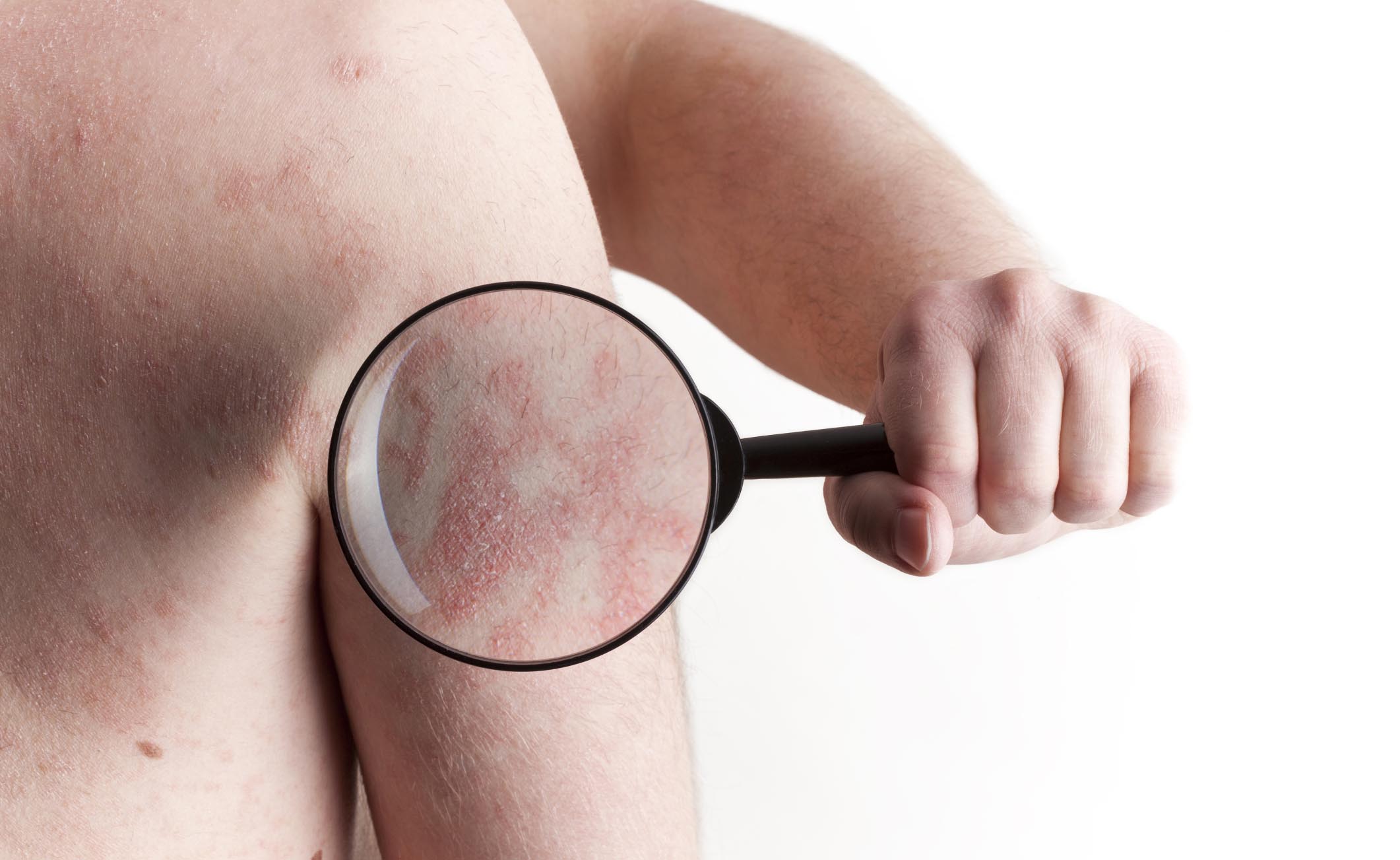 Vivere con la psoriasi