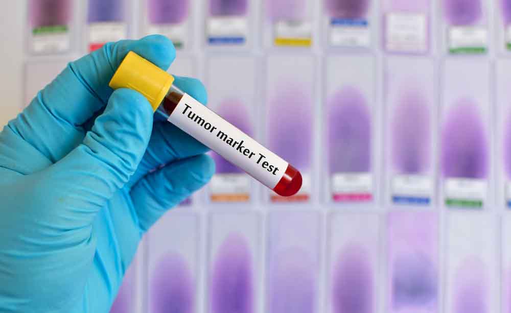 Tumore? Ce lo dirà una semplice analisi del sangue