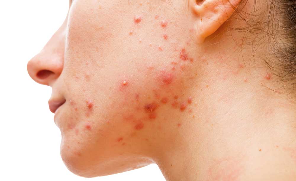 Infezioni della pelle: i brufoli da Stafilococco