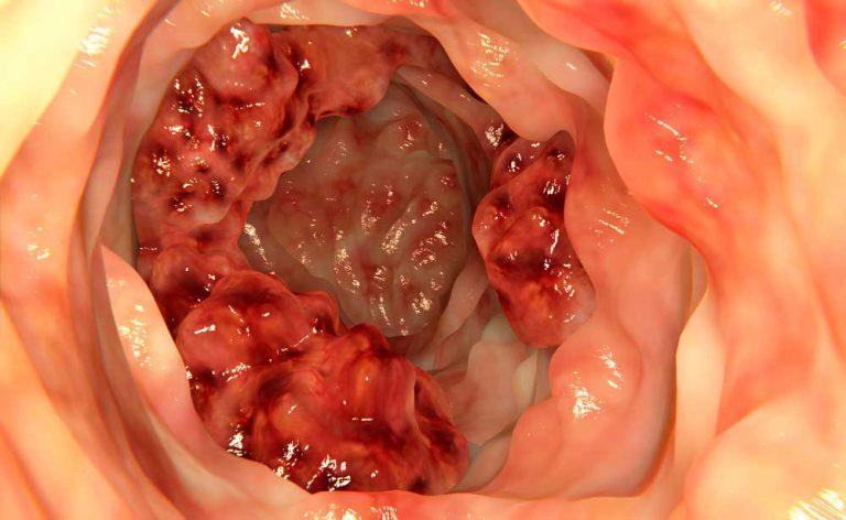 diagnosi tumore colon diagnosi tumore colon