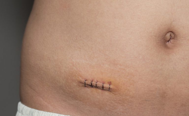 dopo lintervento chirurgico alla prostata la mia vescica non sembra mai essere piena