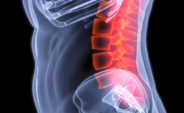 Stenosi vertebrale: curarla senza bisturi