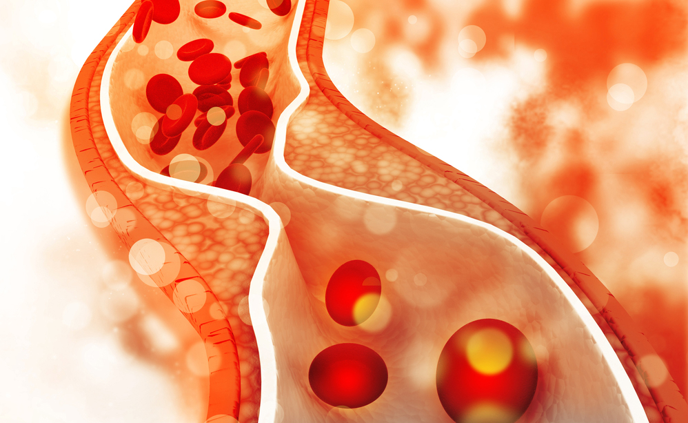 Colesterolo nel sangue cosa accadrebbe se non lo curassimo? Pazienti.it Colesterolo nel sangue cosa accadrebbe se non lo curassimo? Pazienti.it