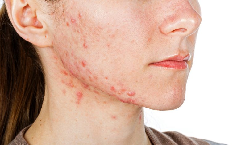 Rimedi per l’acne: i consigli del dermatologo