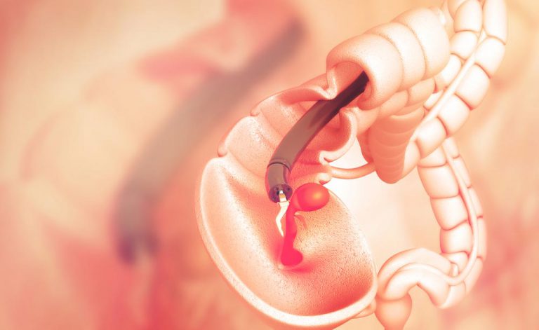 la diverticolite può influenzare la prostata la diverticolite può influenzare la prostata