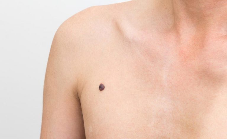 Melanoma Quando Un Neo è Maligno Pazientiit