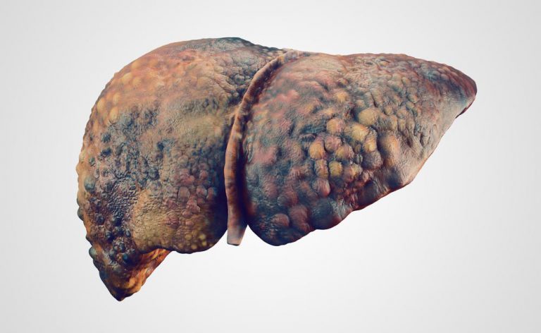 epatocarcinoma e perdita di peso