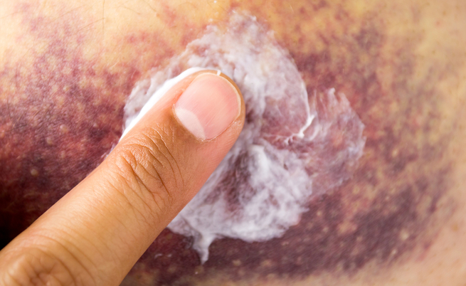 6 cose che non sai sui lividi