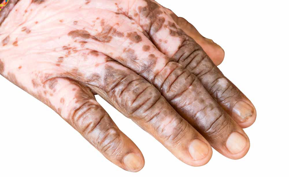 Albinismo e vitiligine: le caratteristiche delle patologie