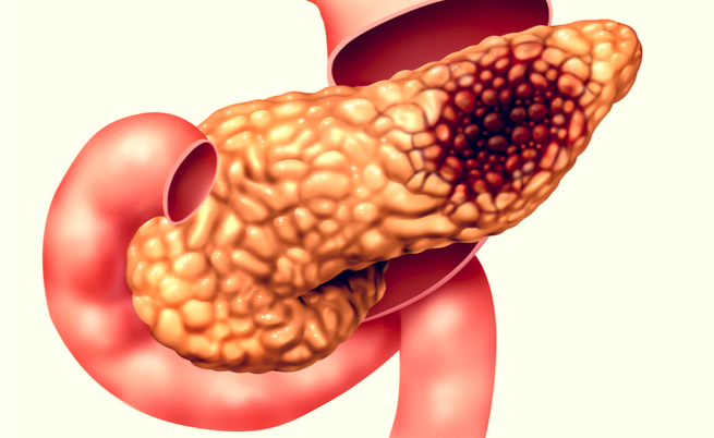 cancro pancreas sopravvivenza cancro pancreas sopravvivenza