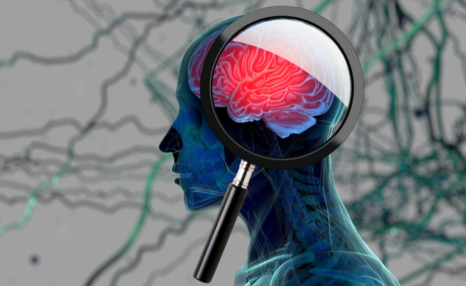 Alzheimer: che colpa ne ha lo zucchero?