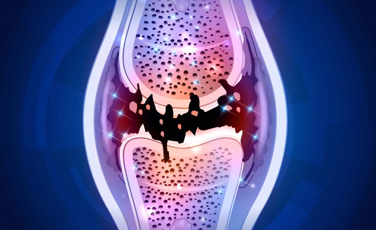 Dolori articolari in menopausa: come trattarli al meglio