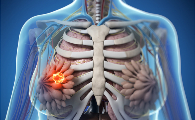 Cancro al seno datazione