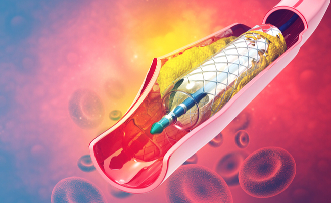 Sclerosi multipla: l’angioplastica è efficace oppure no?