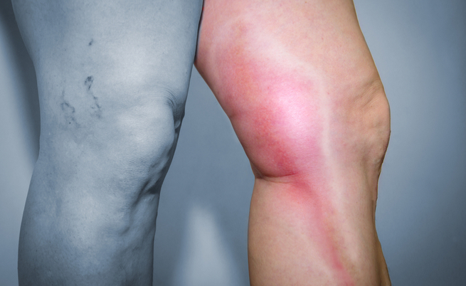 Prurito, gonfiore e non solo: come riconoscere al volo una flebite