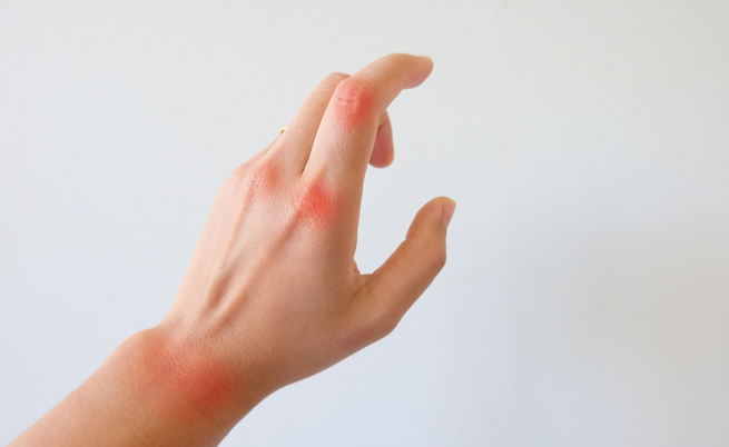 10 cibi per combattere i sintomi dell’artrite reumatoide