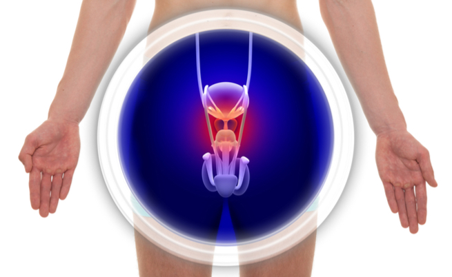 la prostatite cronica è causata dal cancro alla prostata