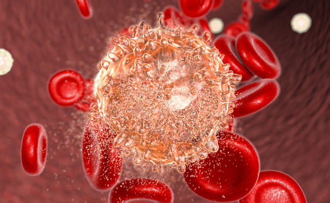 Leucemia: prevedere le ricadute sin dalla diagnosi? Sì, è possibile