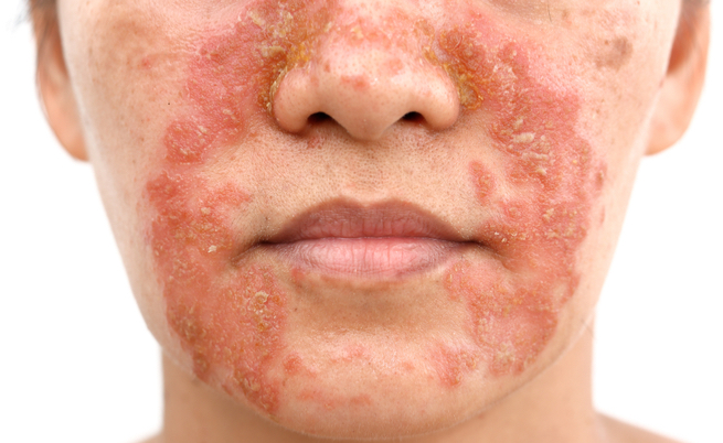 Perchè in primavera dovremmo fare attenzione alla dermatite seborroica