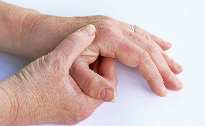 Soffri di artrite psoriasica? I rimedi per alleviare i dolori