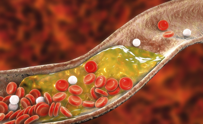 Crampi e dolori alle gambe: potrebbe essere colpa del colesterolo alto