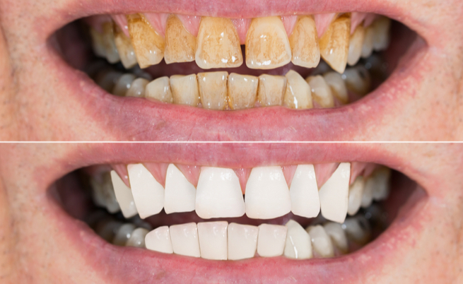11 rimedi naturali per sbiancare i denti gialli