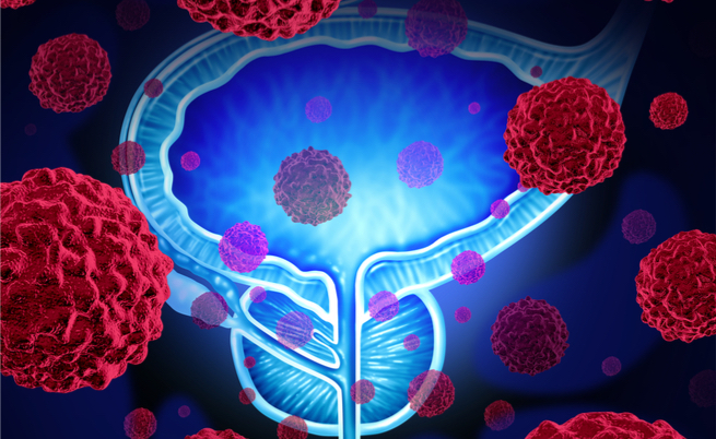 C’è il rischio di tumore alla prostata? Ve lo dicono i test genetici