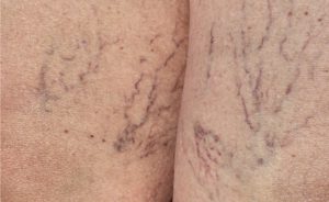 Come eliminare i capillari rotti