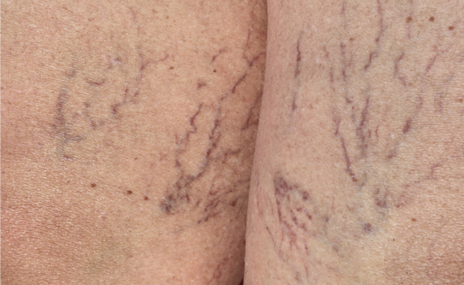 Combattere i capillari rotti: i rimedi più efficaci (naturali ma non solo)