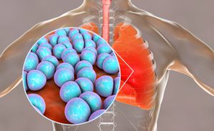 Come prevenire la setticemia: c'è una nuova terapia