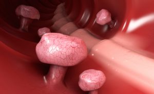 adenoma tubulare: sintomi e cause