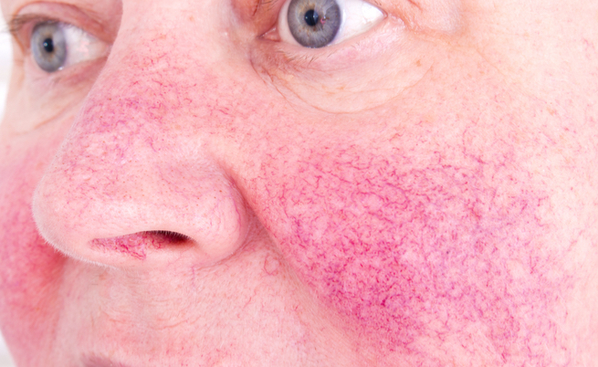 Rosacea in estate: come comportarsi?