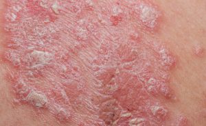 psoriasi esenzione ticket: quando è previsto