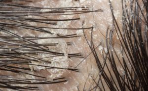 rimedi naturali contro la forfora: ecco i più efficaci