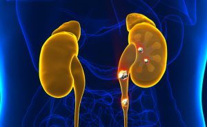 calcoli renali e antibiotici: il legame
