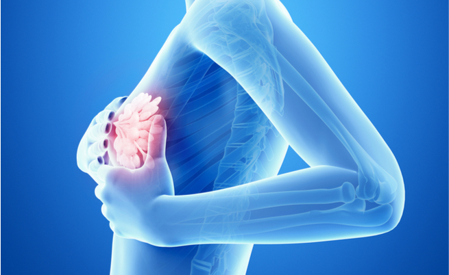 Tumore al seno: forse diremo addio alla chemioterapia