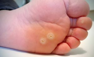 rimedi della nonna per l'occhio di pernice: i più efficaci