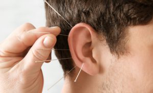 Come funziona l'agopuntura per dimagrire
