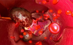 Giornata nazionale dei tumori del sangue
