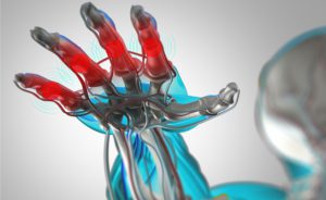 artrite reumatoide e cancro: il legame