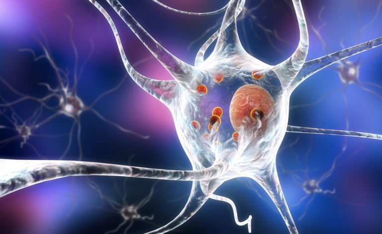 Risultati immagini per parkinson