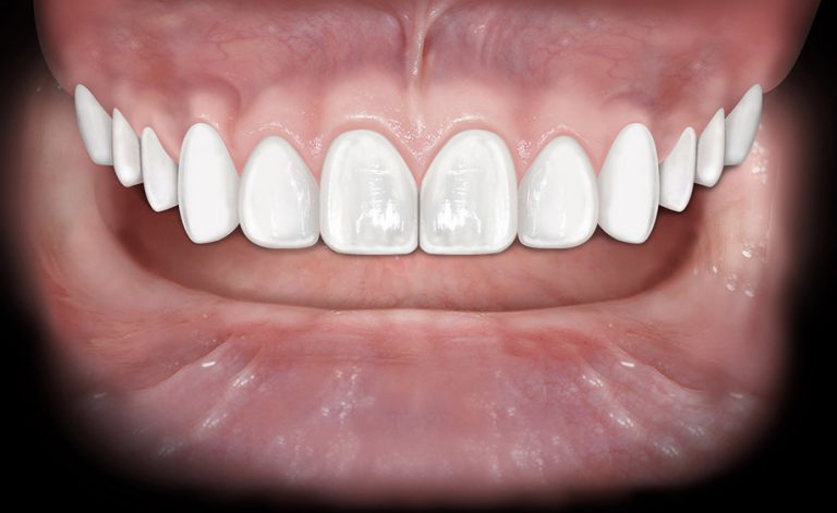Denti disallineati? Una soluzione “invisibile” può prevenire anche carie e piorrea!