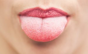 formicolio alla lingua: le cause