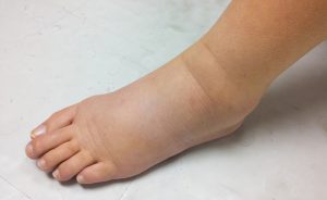 linfedema: la cause e i sintomi
