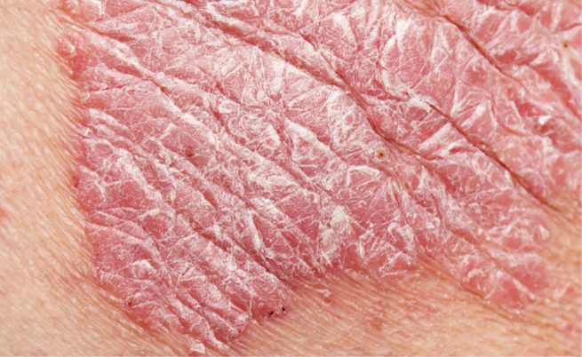 Ci sono 9 fattori che possono far esplodere la psoriasi (e non è solo genetica)