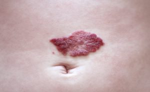 Emangioma