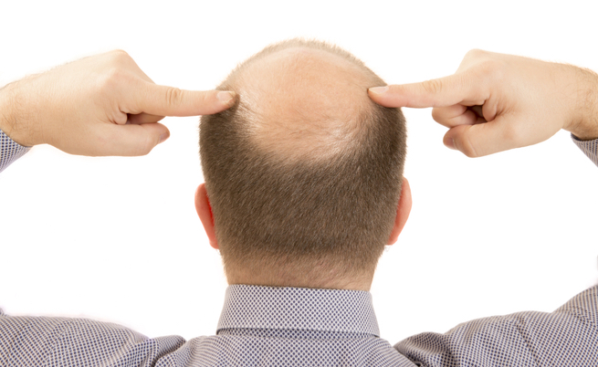 Perché gli uomini perdono più capelli rispetto alle donne?