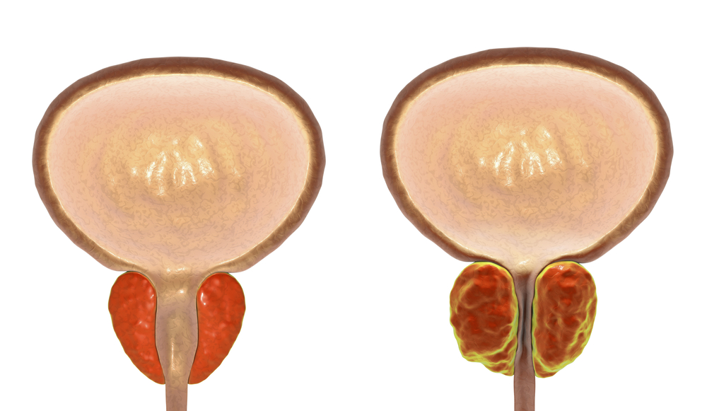 prostata infiammata cause e cura en prostata infiammata cause e cura en