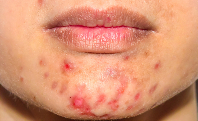 Pelle con acne: come truccarsi? Qualche consiglio (e molti segreti)
